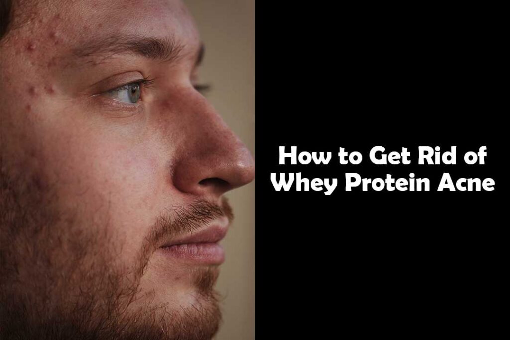 How to Get Rid of Whey Protein Acne